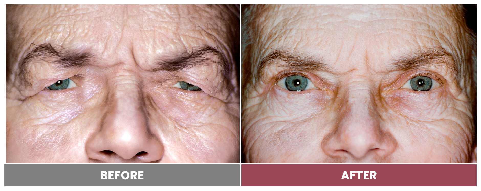 Upper Blepharoplasty - Case 91